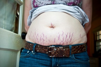 Bad stretch marks? Now what?
