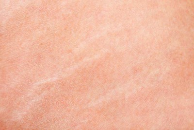 Are pregnancy stretch marks different than other stretch marks?