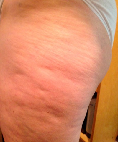 E.M. From New Jersey After Two Weeks With Robelyn’s Cellulite Treatment