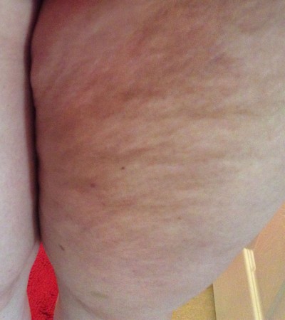 Mid 30-Year Old Female Thigh Cellulite