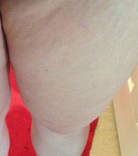 Mid 30-Year Old Female Thigh Cellulite