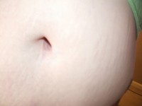Female: Belly Area Stretch Marks During Pregnancy