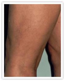 After Image of Varicose Veins on a person's leg