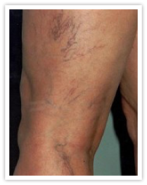 Before Image of Varicose Veins on a person's leg