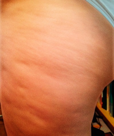 E.M. From New Jersey After Two Weeks With Robelyn’s Cellulite Treatment