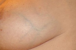 Old varicose veins on breast