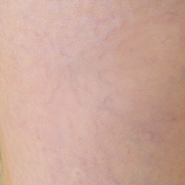 Female: Varicose Veins on Left Calf