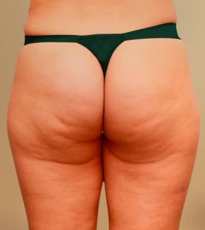 Study Subject #1 - Robelyn’s Cellulite Treatment