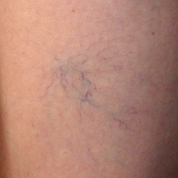 Female: Varicose Veins on Left Calf