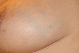 Old varicose veins on breast
