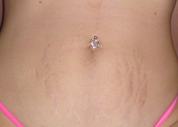 Bad belly stretch marks