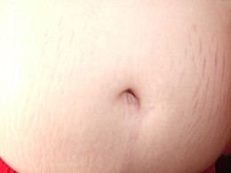 Female: Belly Area Stretch Marks During Pregnancy
