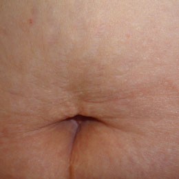 Female: Twenty-Five Year Old Stretch Marks