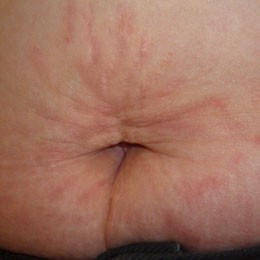 Female: Twenty-Five Year Old Stretch Marks