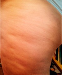 E.M. From New Jersey After Two Weeks With Robelyn’s Cellulite Treatment