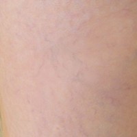 Female: Varicose Veins on Left Calf